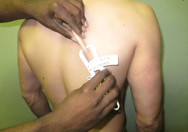 Subscapular skinfold measurement